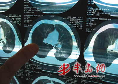 ct显示患者肺部有空洞